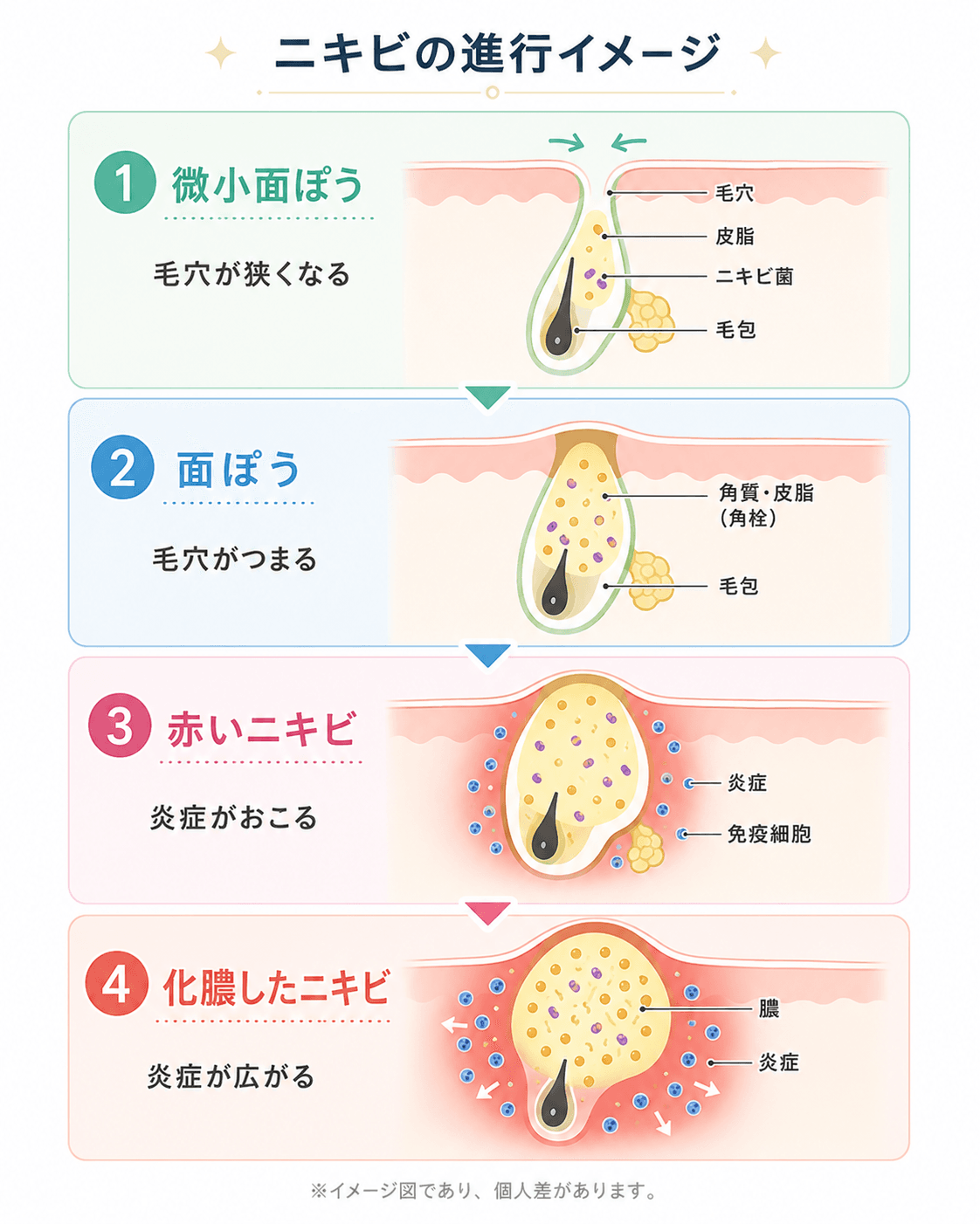 ニキビの種類・状態の説明図