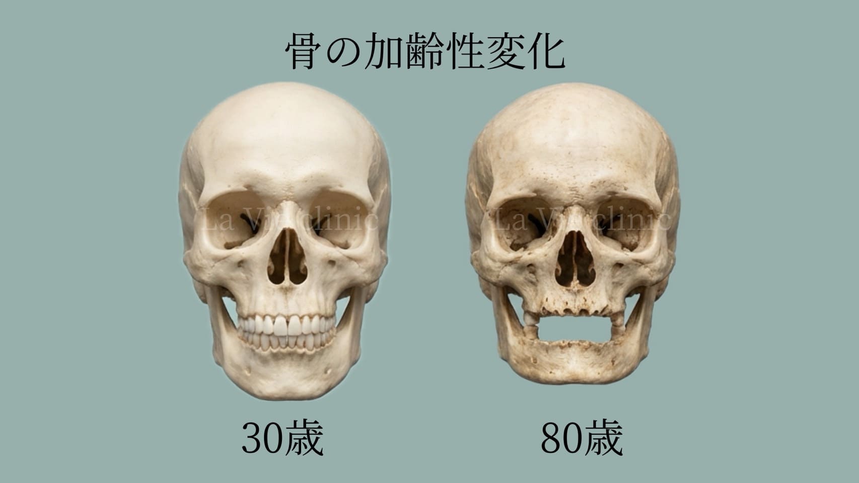 加齢による顔面骨の変化1