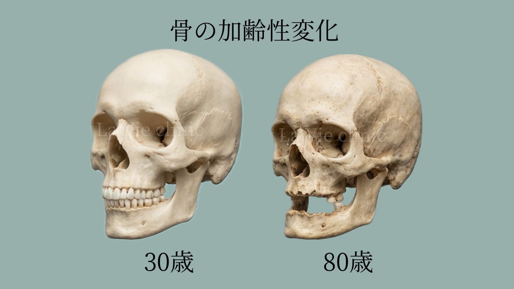 加齢による顔面骨の変化2