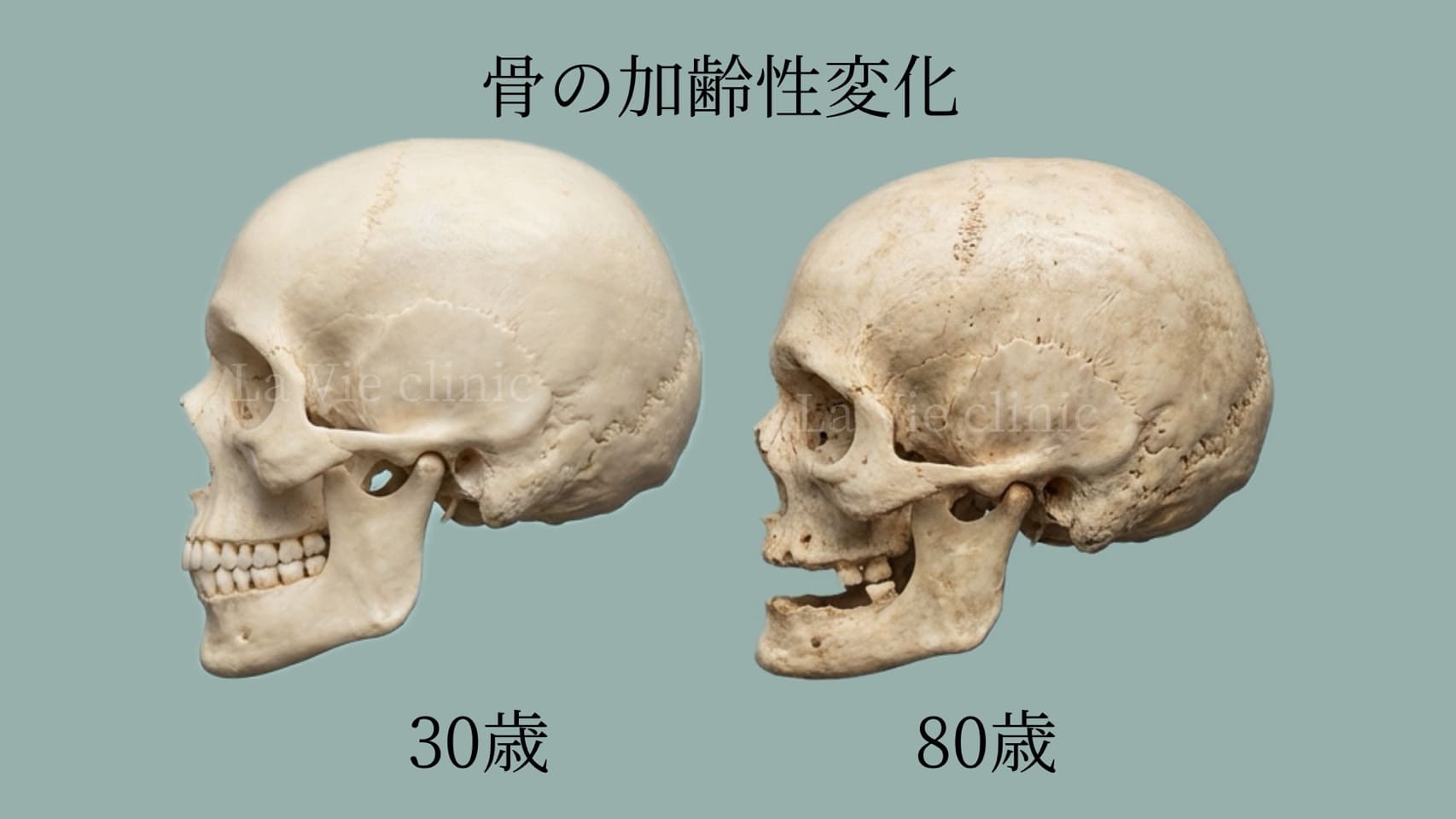 加齢による顔面骨の変化3