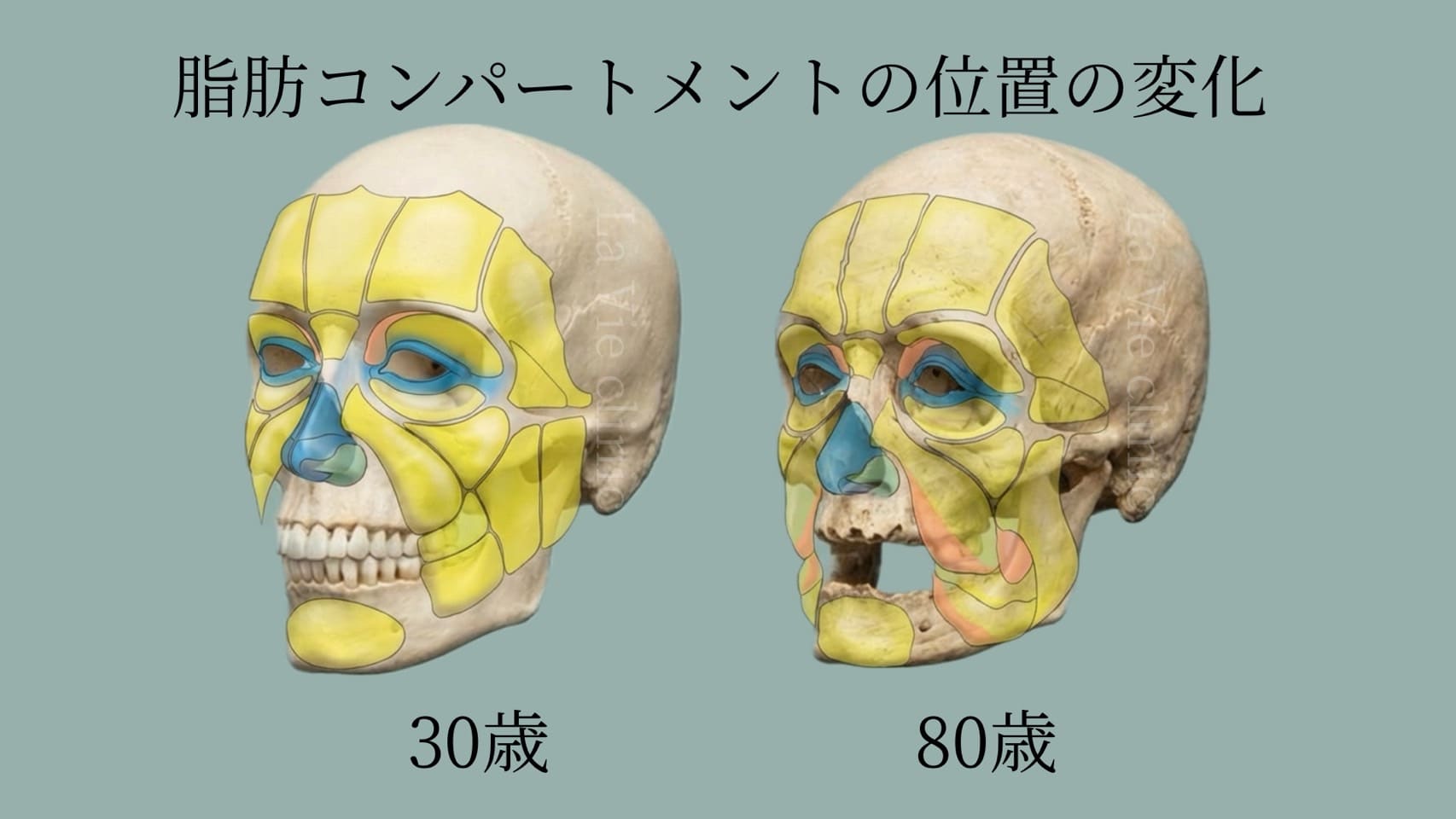 顔面脂肪区画の変化イラスト - 浅層脂肪と深層脂肪の位置関係