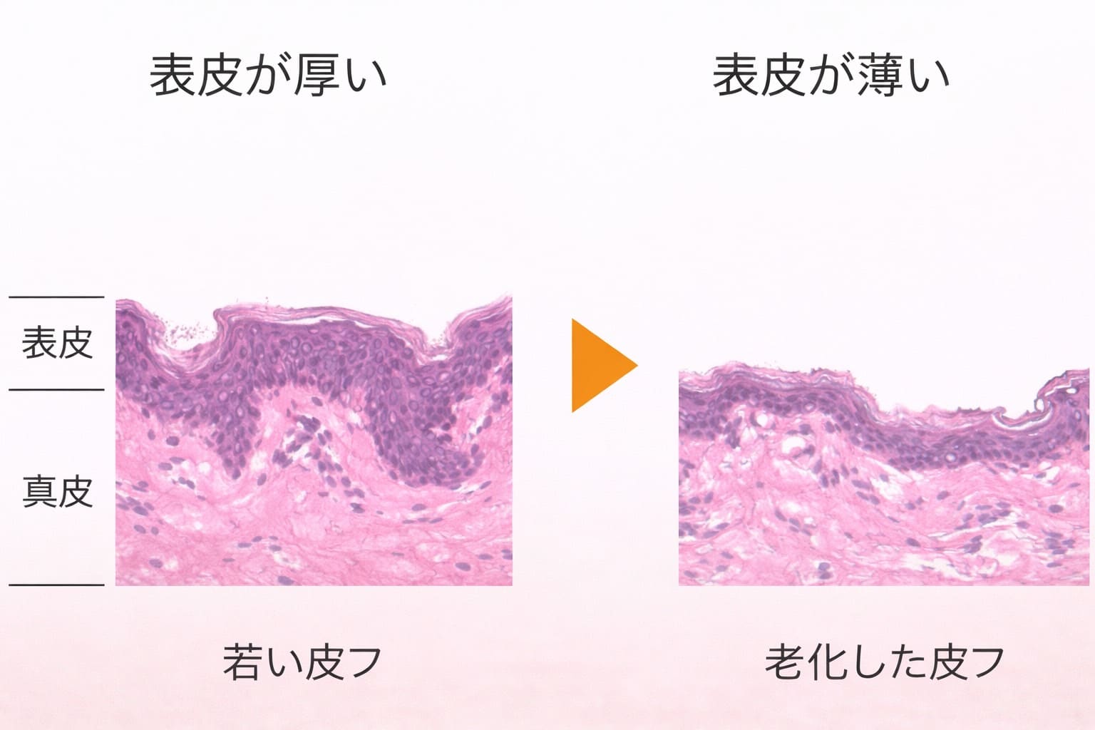 表皮バリア機能イラスト - 健康な表皮と機能低下した表皮の比較