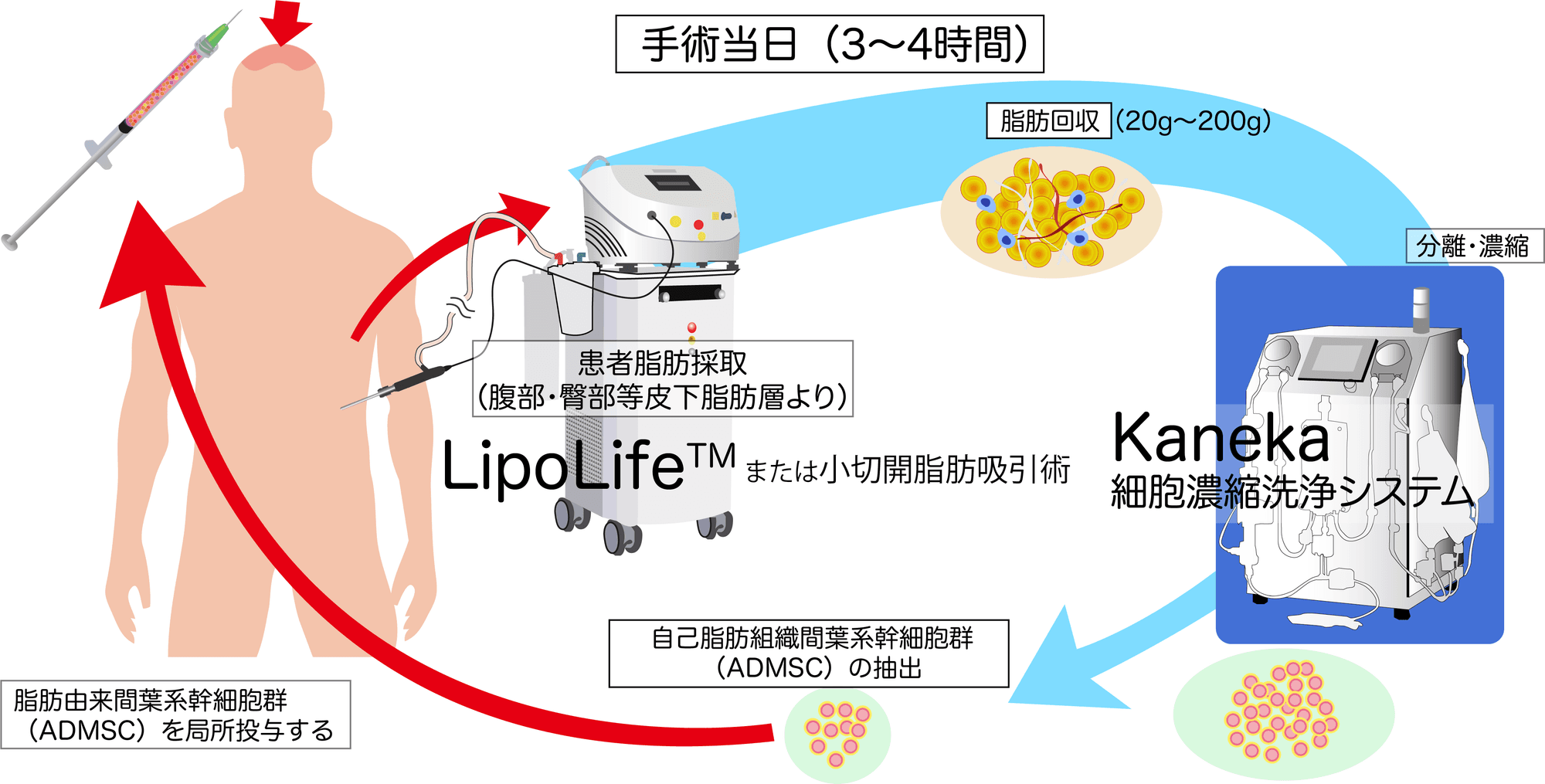 自家脂肪幹細胞を用いた毛髪再生治療のプロセス図解