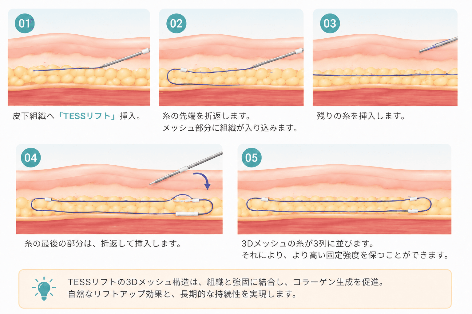テスリフト 挿入方法
