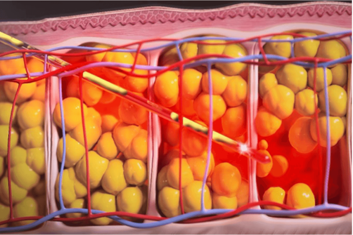 LipoLifeレーザー照射による脂肪細胞吸引イメージ