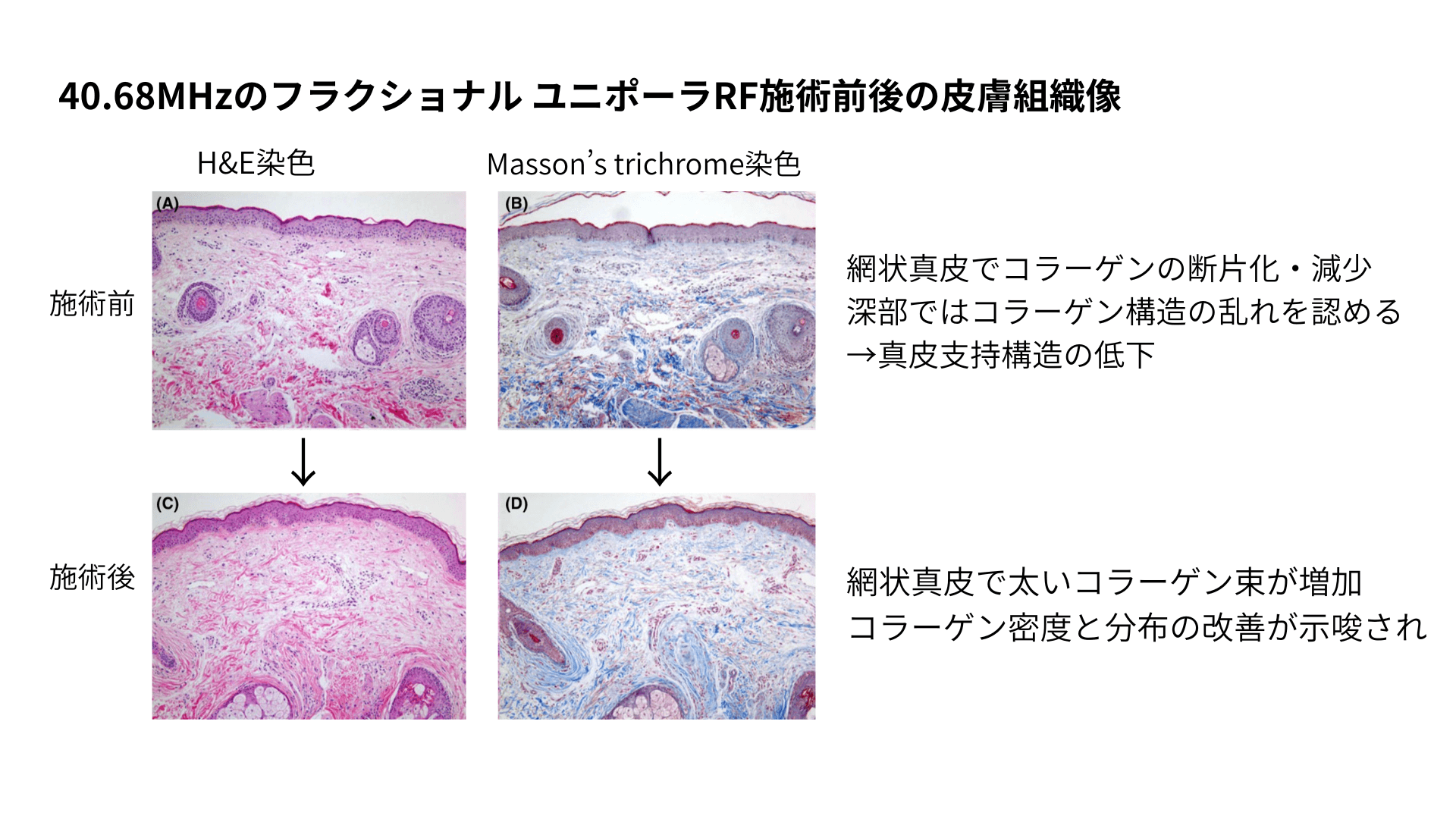 40.68MHzのフラクショナル ユニポーラRF施術前後の皮膚組織像